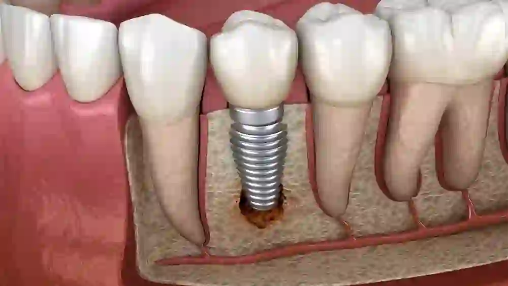 Dental Implants